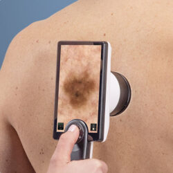 Dermatoskopisk bilde tatt med Canfield D2